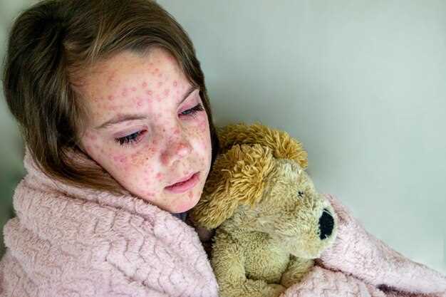 Сыпь при ветрянке как выглядит на начальных стадиях